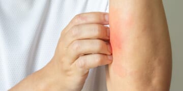 Ivermectin is now available in a cream that can be used to treat a variety of skin problems.