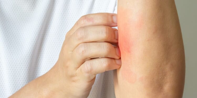 Ivermectin is now available in a cream that can be used to treat a variety of skin problems.