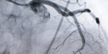 Beyond statins: Experimental cholesterol-lowering pill may offer new option for millions