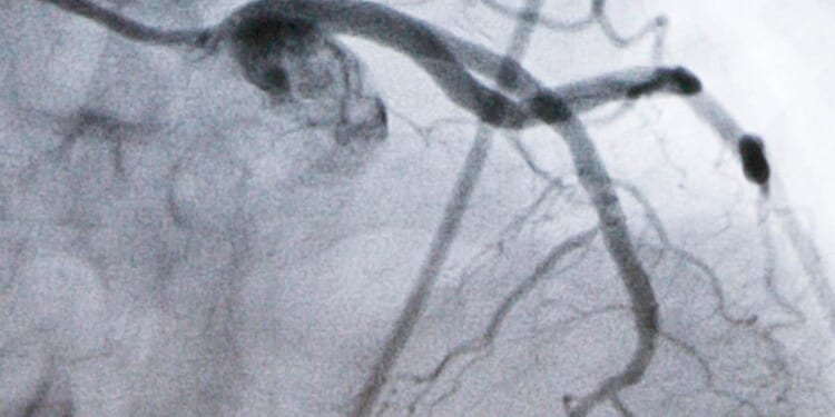 Beyond statins: Experimental cholesterol-lowering pill may offer new option for millions